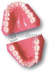 ECCO - Orthodontic 1999-1 Class II Div I Sub Div Left - Practice Model -