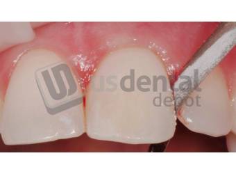 Metal Polishing Strips single sided 12/Pkg Ea. – Florida Dental Supply