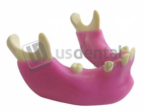 IMPLANTOSS - M-430 ImplantOSS Student Model -Mandible with some teeth and Gum #4012G ( Patient education student models )