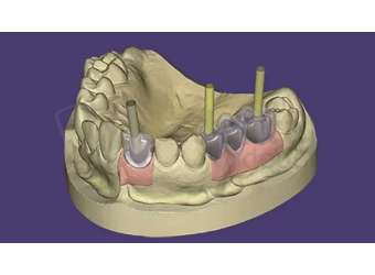 EXOCAD - Implant Module. Perpetual License Upgrade Contract, per year from year two. exocad dental CAD software license, delivered electronically, no physical shipment. USDD item 701005P-Y2. - # 701005P-Y2