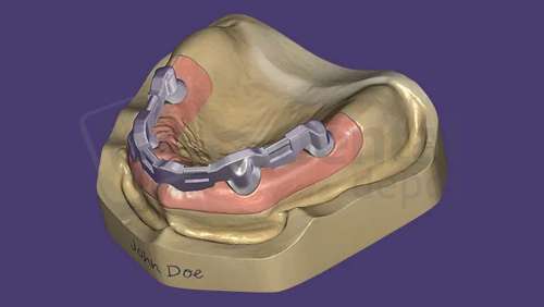 EXOCAD - Bar Module. Perpetual License including the first year of software upgrades. exocad dental CAD software license, delivered electronically, no physical shipment. USDD item 701006P-Y1. - # 701006P-Y1