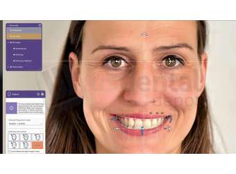 EXOCAD - Smile Creator Module. Perpetual License Upgrade Contract, per year from year two. exocad dental CAD software license, delivered electronically, no physical shipment. USDD item 701009P-Y2. - # 701009P-Y2