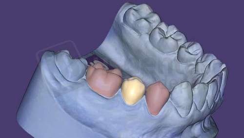 EXOCAD - Provisional Module. Perpetual License including the first year of software upgrades. exocad dental CAD software license, delivered electronically, no physical shipment. USDD item 701002P-Y1. - # 701002P-Y1