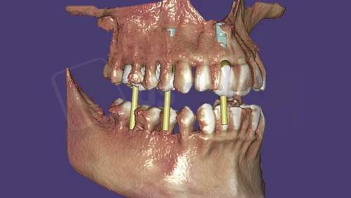 EXOCAD - DICOM Viewer Module. Perpetual License including the first year of software upgrades. exocad dental CAD software license, delivered electronically, no physical shipment. USDD item 701007P-Y1. - # 701007P-Y1