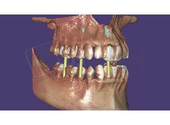 EXOCAD - DICOM Viewer Module. Perpetual License Upgrade Contract, per year from year two. exocad dental CAD software license, delivered electronically, no physical shipment. USDD item 701007P-Y2. - # 701007P-Y2