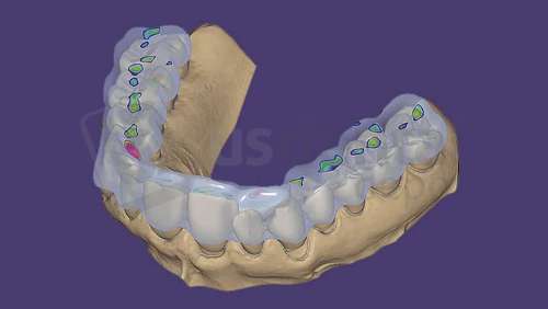 EXOCAD - Bite Splint Module. Perpetual License Upgrade Contract, per year from year two. exocad dental CAD software license, delivered electronically, no physical shipment. USDD item 701014P-Y2. - # 701014P-Y2