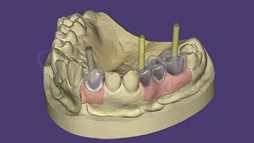EXOCAD - Implant Module. Flex Annual plan yearly renewal fee from year two. exocad dental CAD software license, delivered electronically, no physical shipment. USDD item 701005F-Y2. - # 701005F-Y2