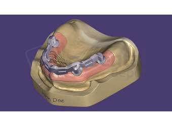 EXOCAD - Bar Module. Flex Annual plan initial fee for year one. exocad dental CAD software license, delivered electronically, no physical shipment. USDD item 701006F-Y1. - # 701006F-Y1