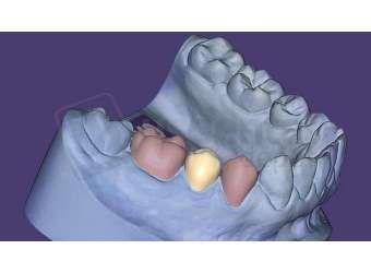 EXOCAD - Provisional Module. Flex Annual plan yearly renewal fee from year two. exocad dental CAD software license, delivered electronically, no physical shipment. USDD item 701002F-Y2. - # 701002F-Y2