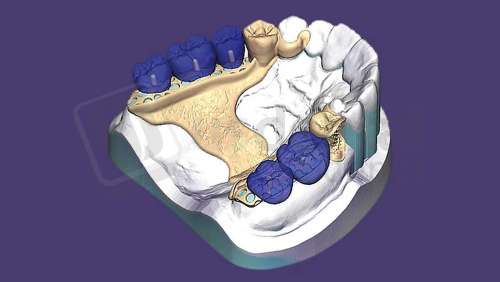 EXOCAD - PartialCAD Module for DentalDB. Flex Annual plan yearly renewal fee from year two. exocad dental CAD software license, delivered electronically, no physical shipment. USDD item 701013F-SA-Y2. - # 701013F-SA-Y2