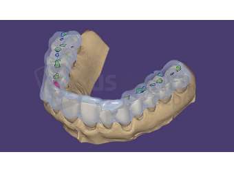 EXOCAD - Bite Splint with Virtual Articulator for DentalDB. Flex Annual plan initial fee for year one. exocad dental CAD software license, delivered electronically, no physical shipment. USDD item 701014F+701001F-SA-Y1. - # 701014F+701001F-SA-Y1