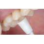 SHOFU OneGloss OneGloss Refill -  50px ., unmounted,CUPS    50px . #0181