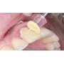 SHOFU -  CA SUPER-SNAP    Metalic Mandrels - Refill - #0439 ( Contrangle )