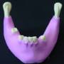 IMPLANTOSS - M-430 ImplantOSS Student Model -Mandible with some teeth and Gum #4012G ( Patient education student models )