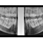 GENORAY PAPAYA 3D LITE 18S 3D PANORAMIC & CBCT  16X8