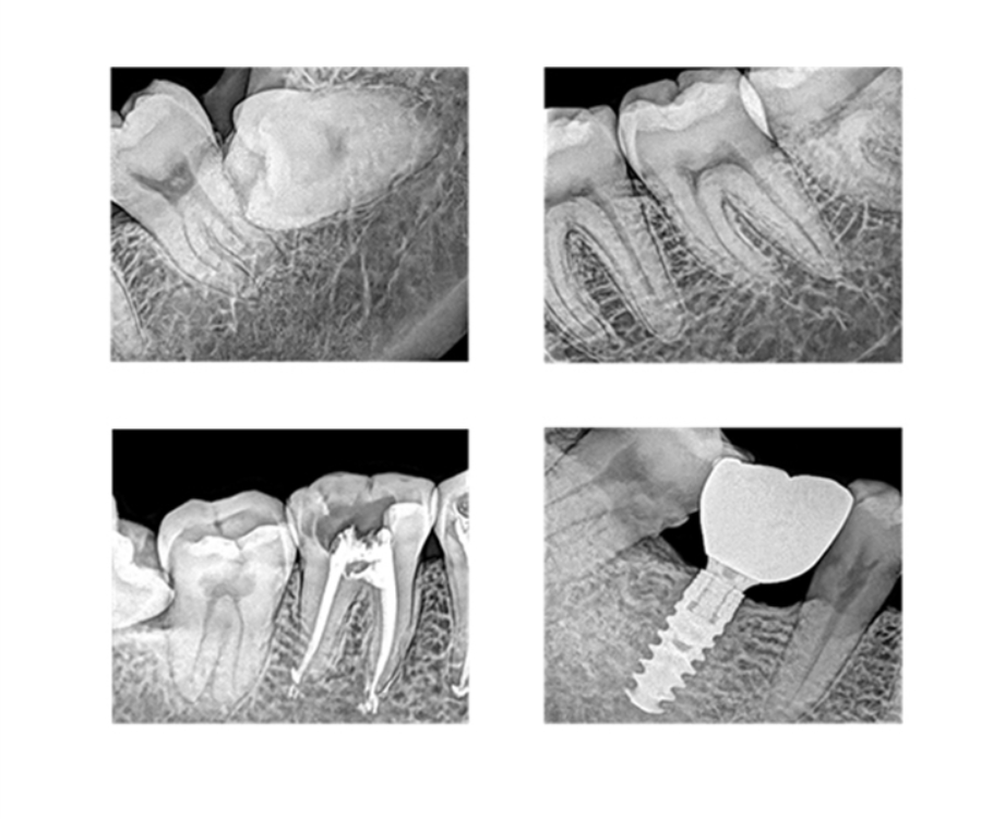 XPECT VISION DENTAL SENSOR Xpect Vision XVD2121 Plus US Dental Depot