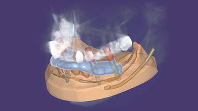 exocad exoplan