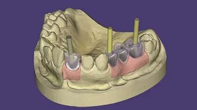 exocad Implant Module
