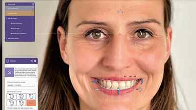 exocad Smile Creator