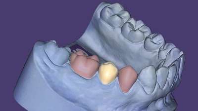 exocad Provisional