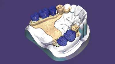 exocad PartialCAD